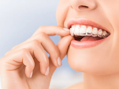 What Is The Cost Difference Between Invisalign And Metal Braces?