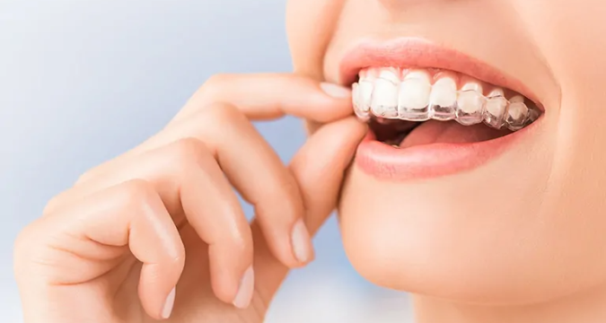 What Is The Cost Difference Between Invisalign And Metal Braces?